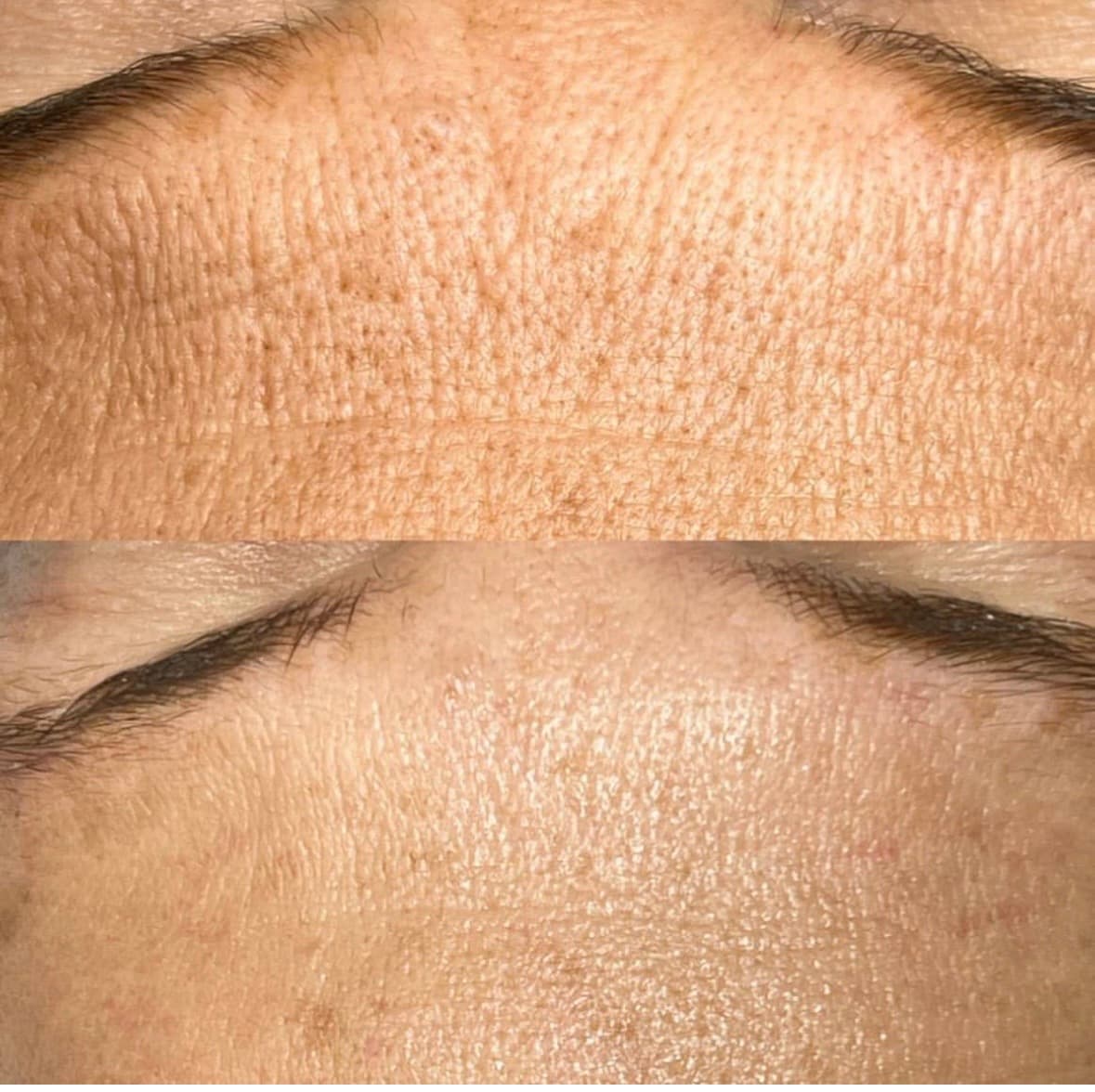 Before & After. Forehead Texture Transformation